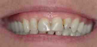 Who should not get an implant?