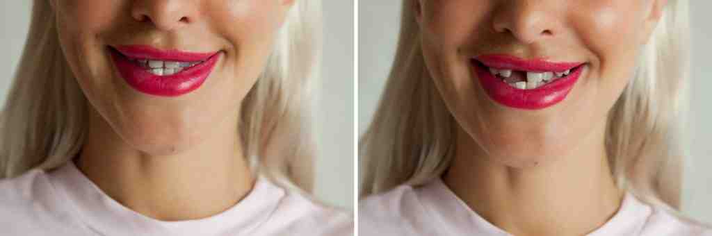 Who should not get an implant?