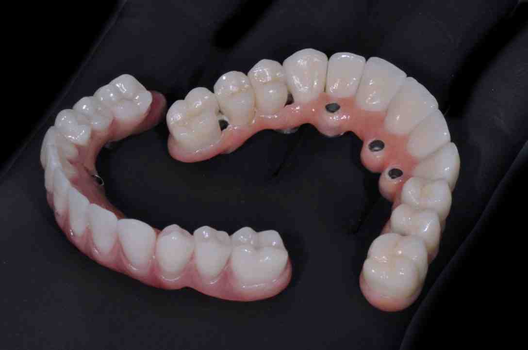 Who should not get an implant?