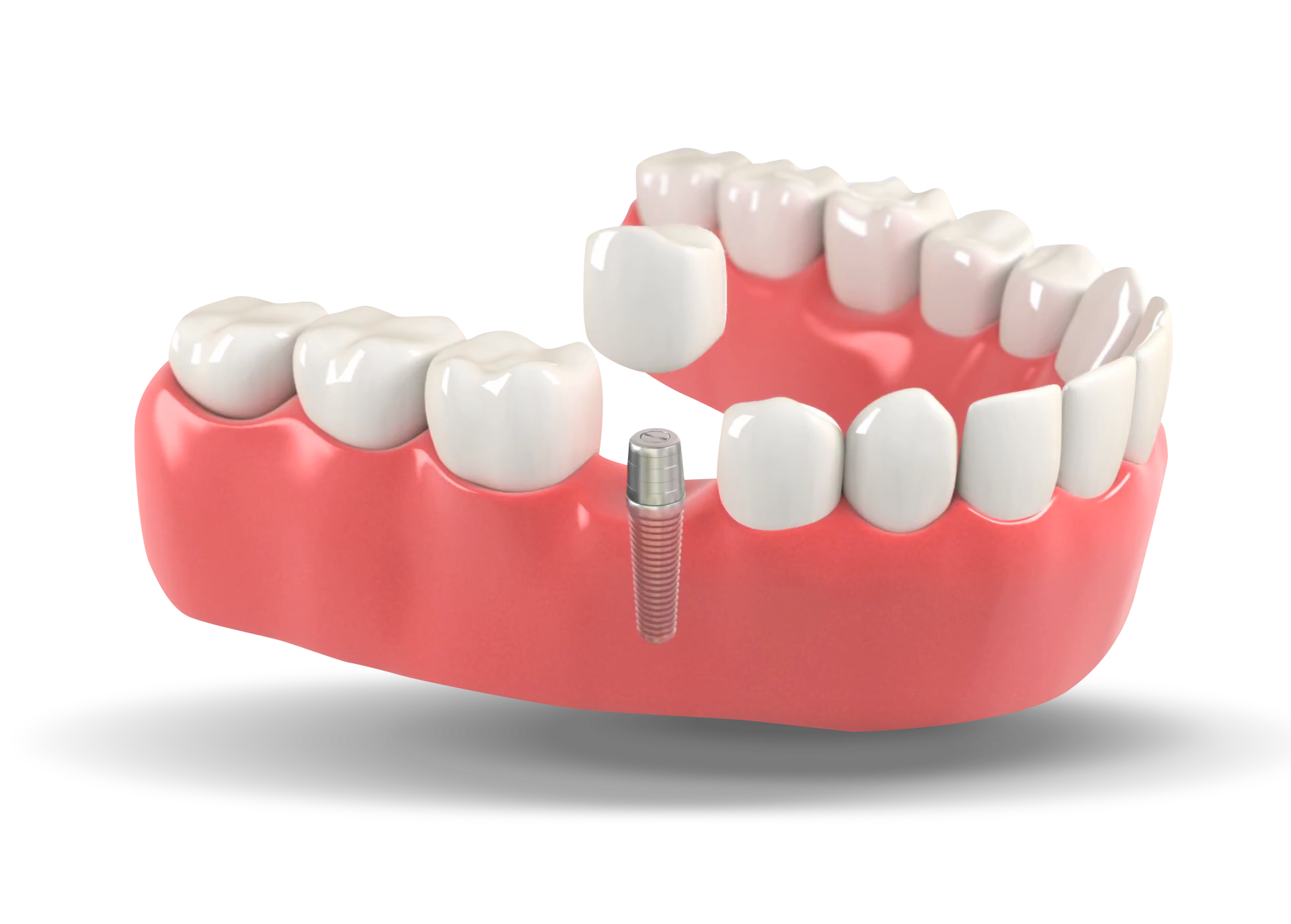 Who should not get an implant?
