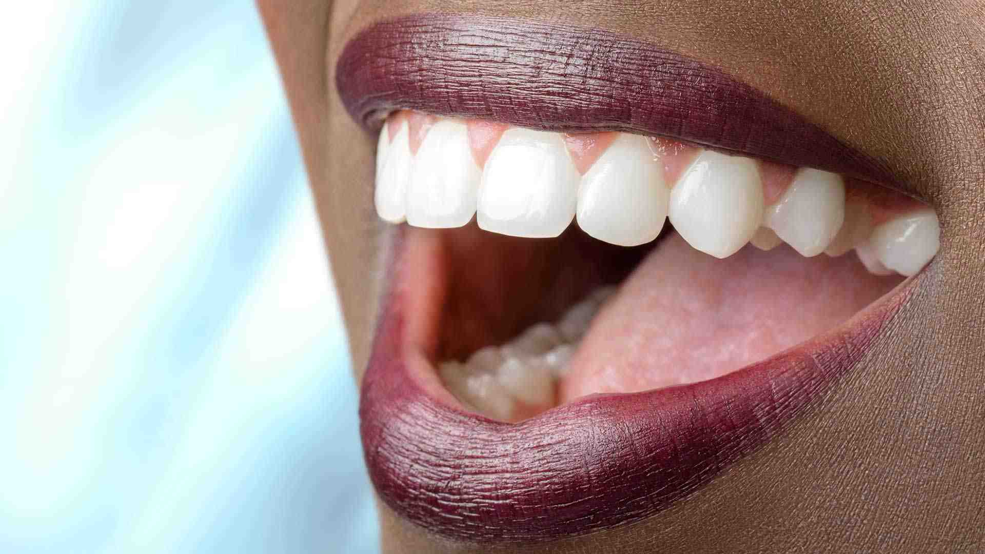 Who should not get veneers?