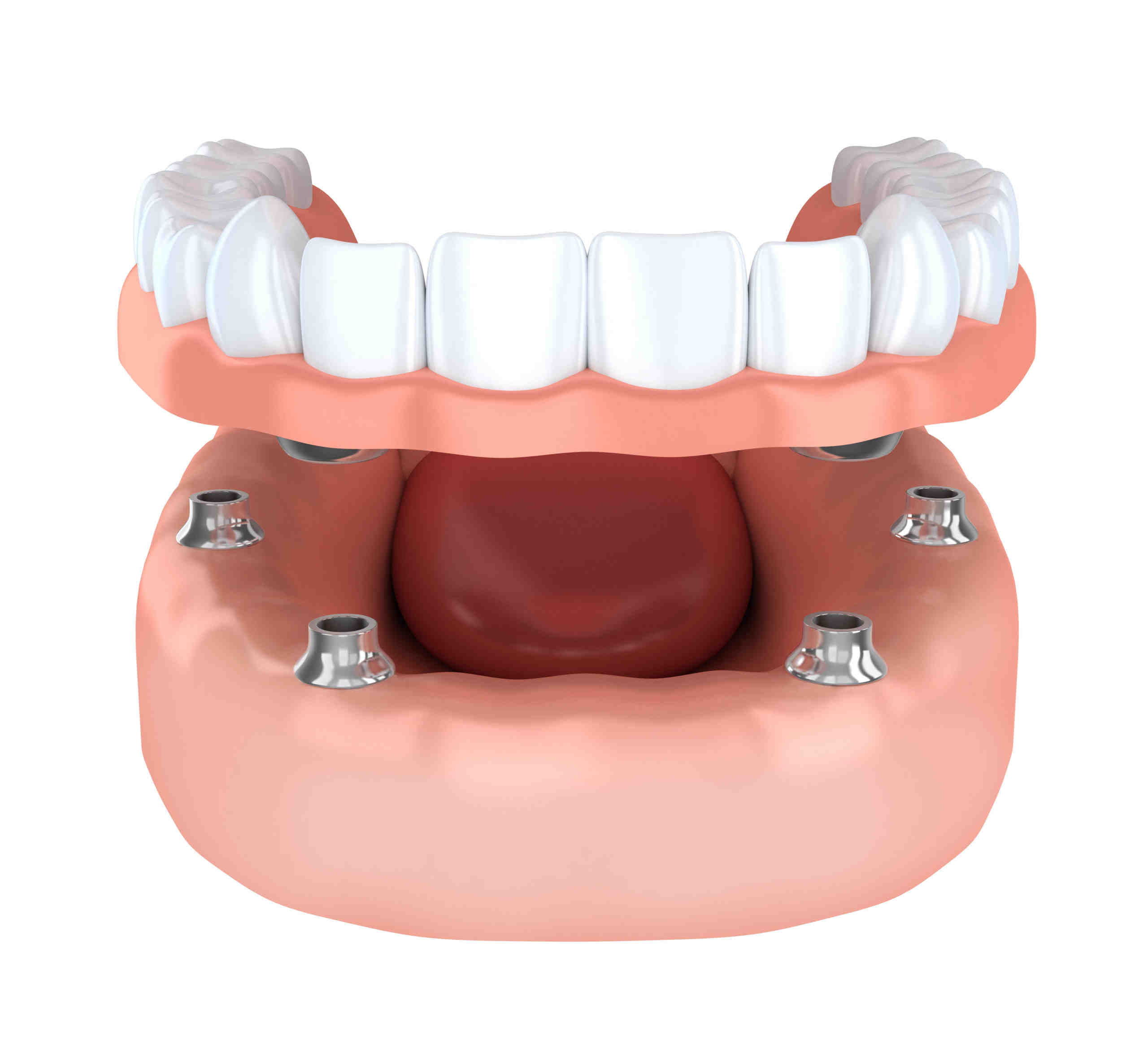 Why am I not suitable for dental implants?
