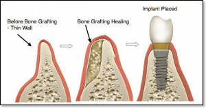 Why are dental bone grafts so expensive?