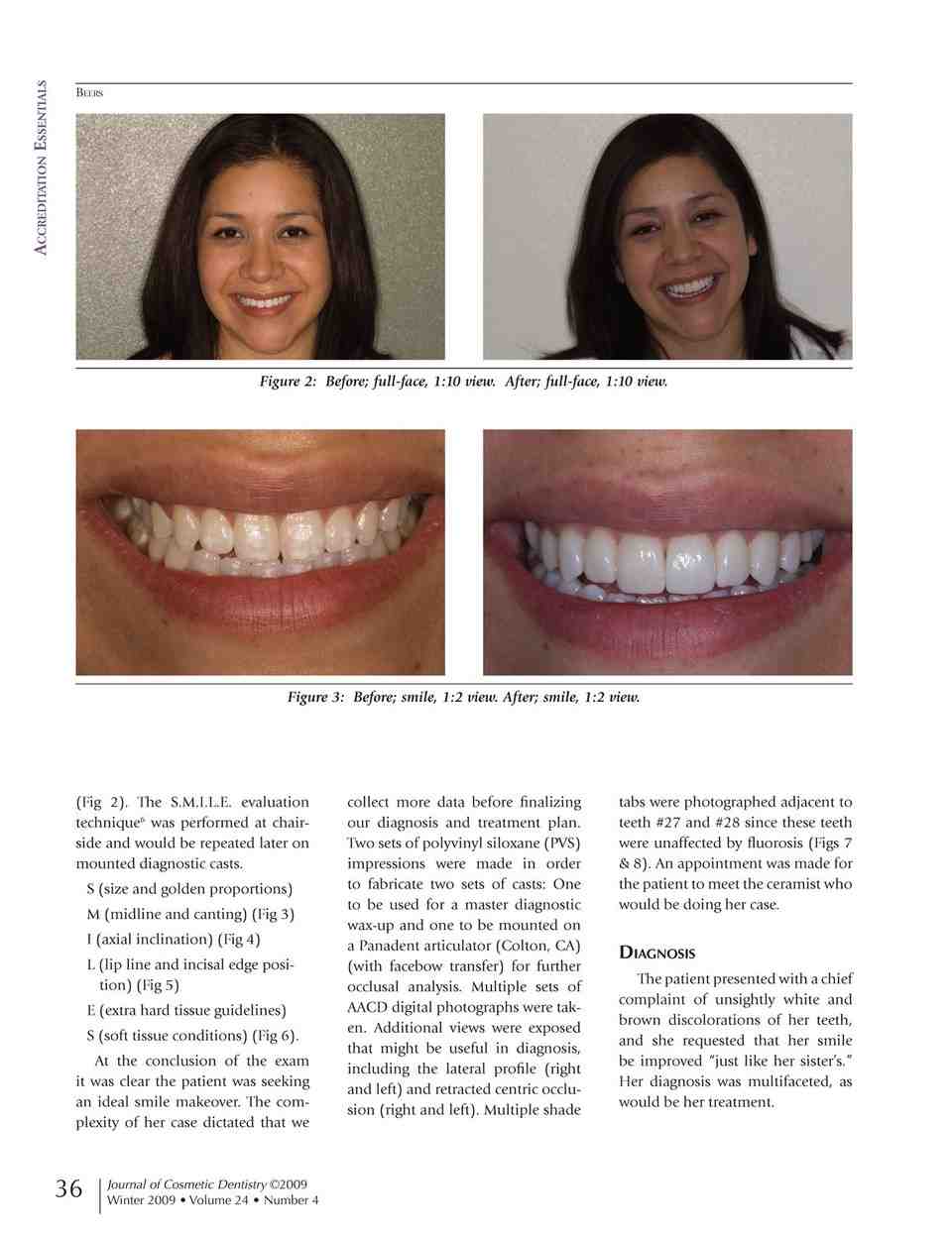 Why are veneers so popular?