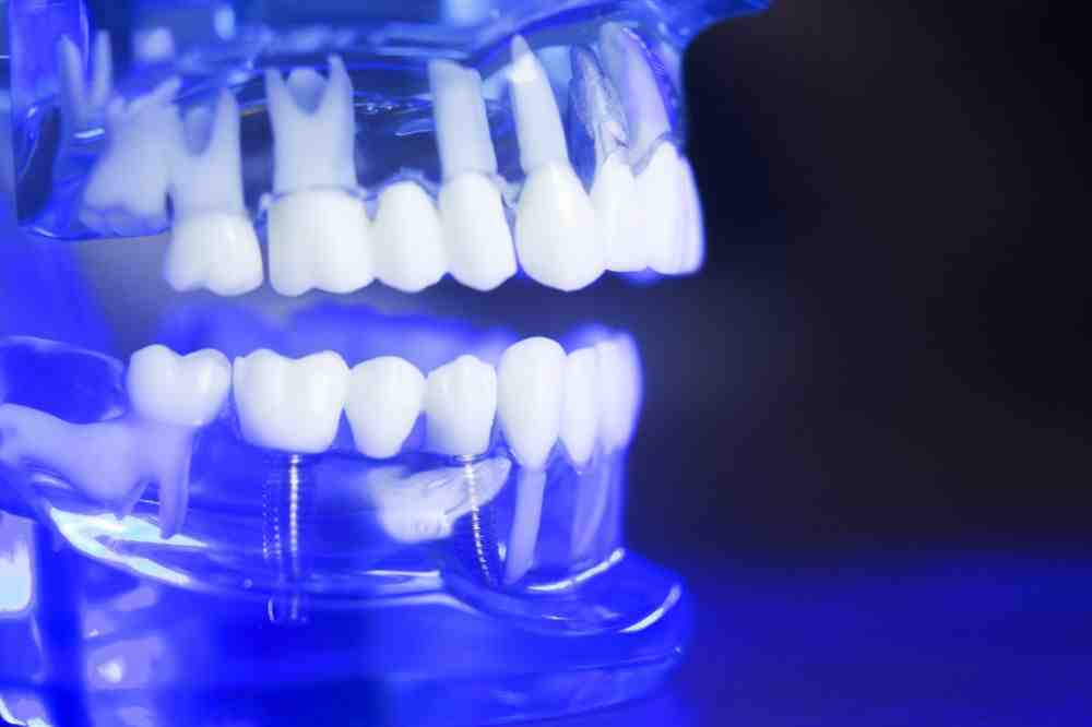 Why arent my teeth straight after braces?