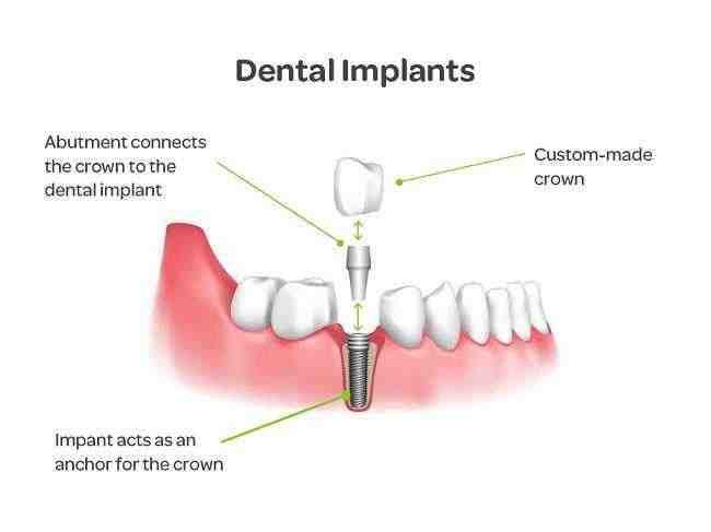 Why choose a dental bridge over an implant?