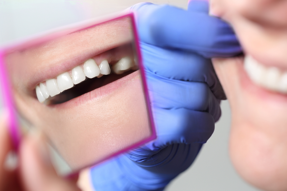 Why choose a dental bridge over an implant?