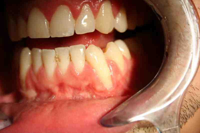 Why do gums recede around crowns?
