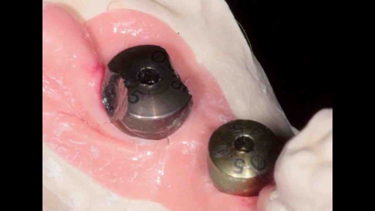 Why do gums recede around implant?