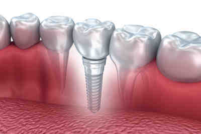 Why do gums recede around implant?