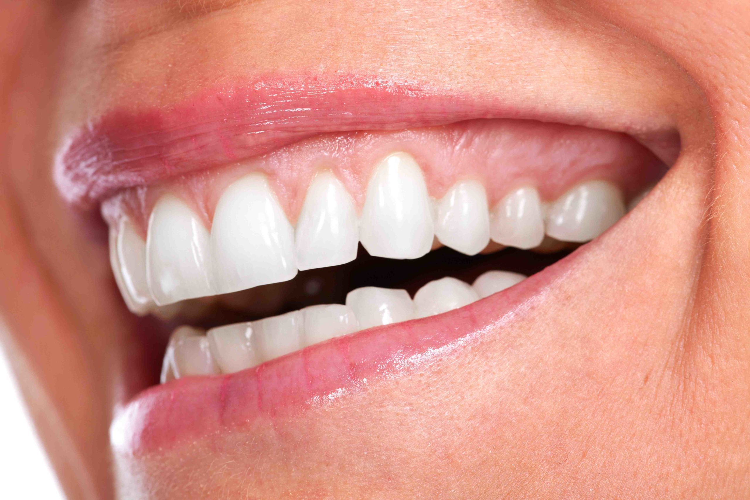 Why do gums recede around implant?