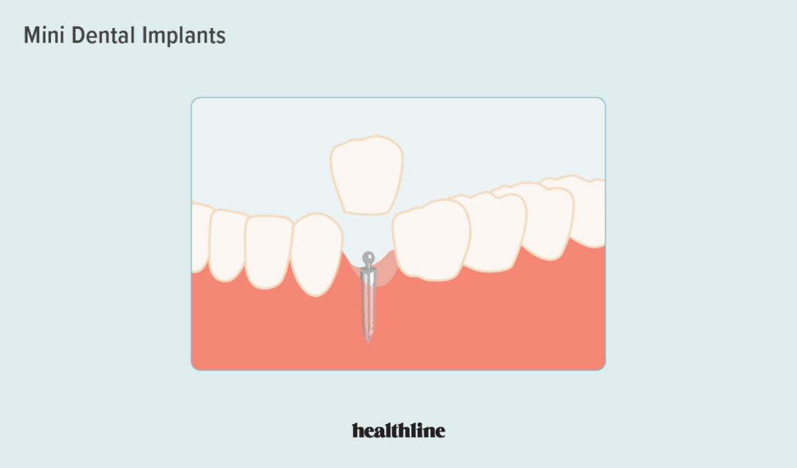 Why do mini implants fail?