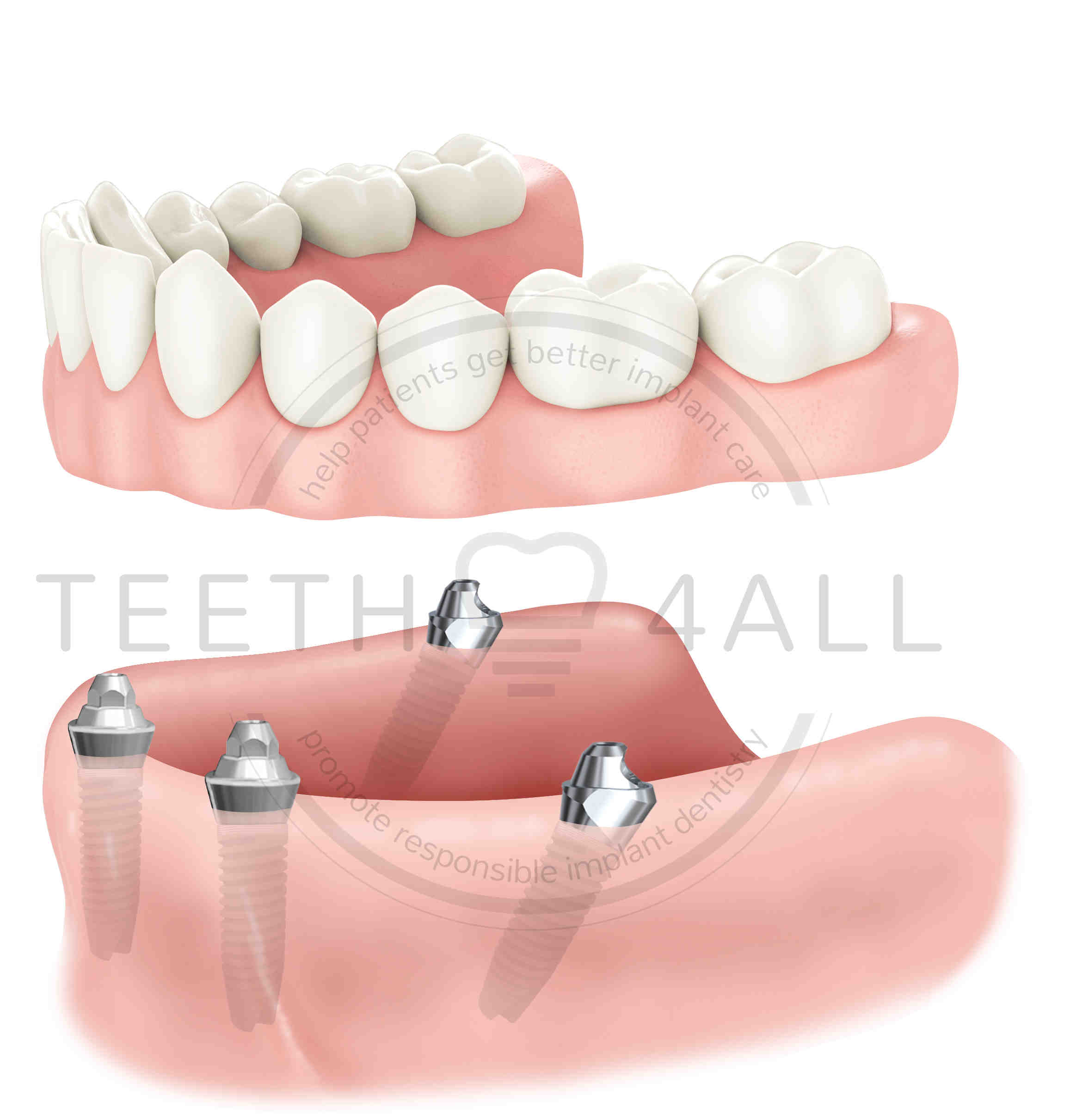 Why do my dentures look like buck teeth?