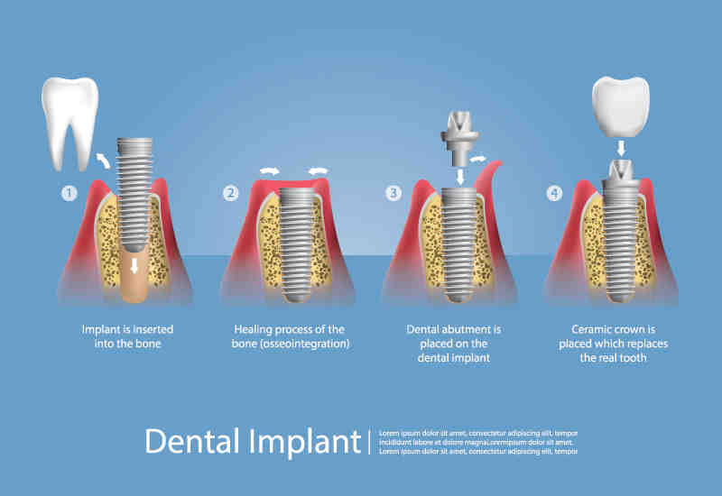 Why do tooth implants cost so much?