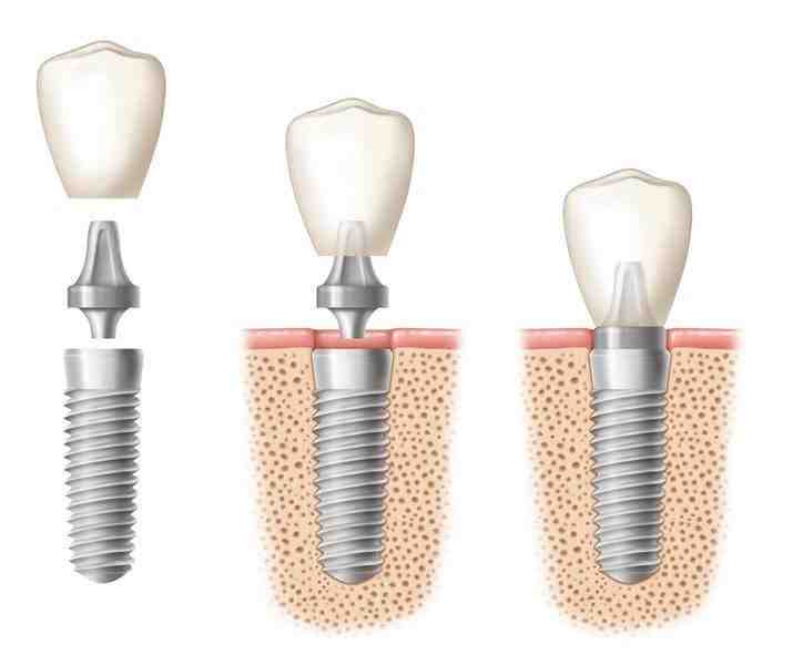 Why does my tooth implant hurt years later?