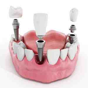 Why does my tooth implant look blue?