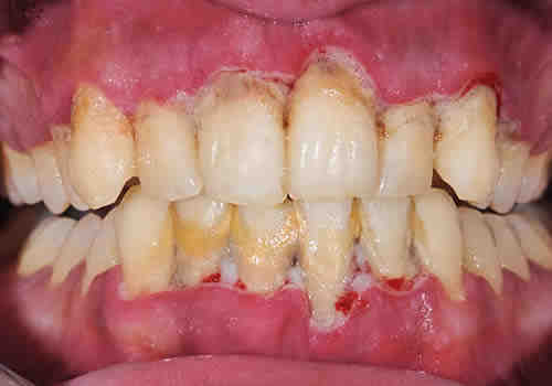 Why does my tooth implant smell bad?