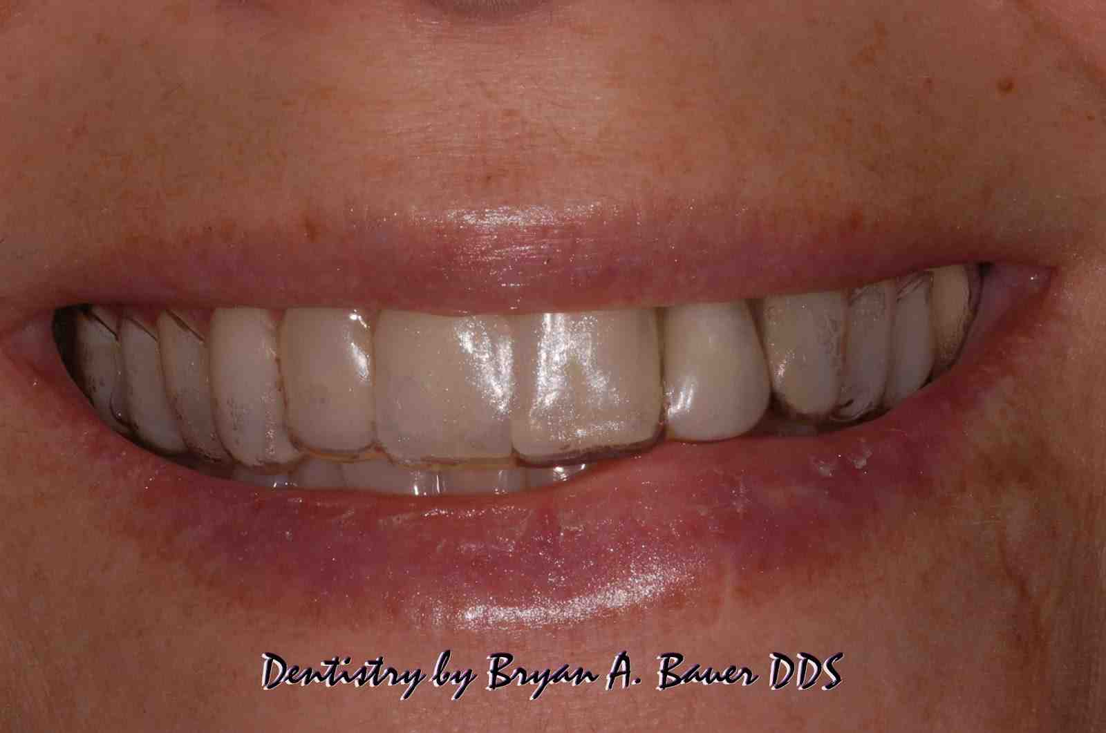 Why does the tooth next to my implant hurt?