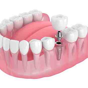 Why is my broken tooth black?