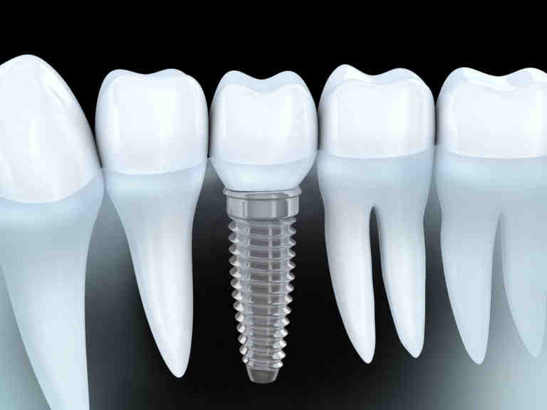 Why is my dental implant turning black?