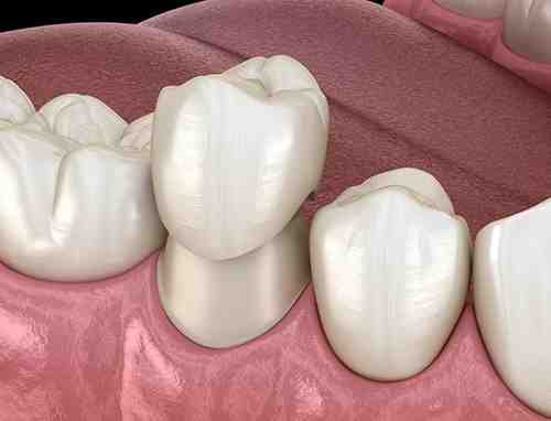 Why is my dental implant wobbly?