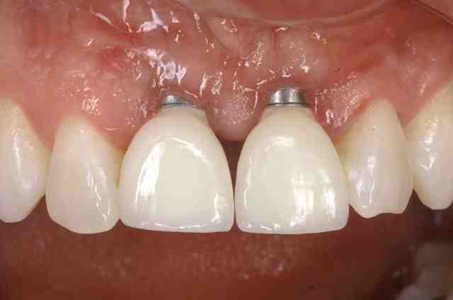 Why is my implant throbbing?
