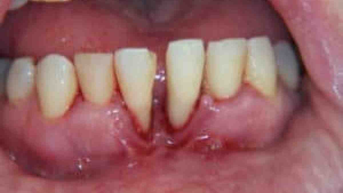 Why would someone not get dental implants?