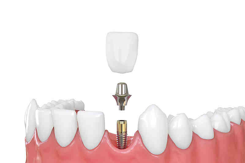 Will 2 implants hold bottom dentures in place?