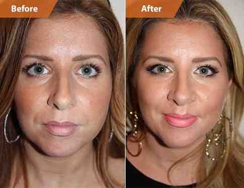 Will a chin implant elongate my face?