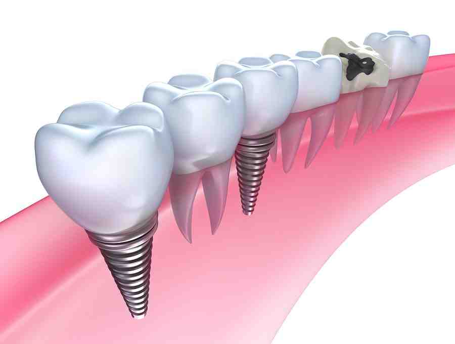 Will dental implants get cheaper in the future?