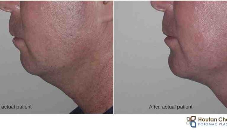 Will dental work cause my chin implant to shift
