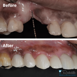 Will gums grow over bone graft?