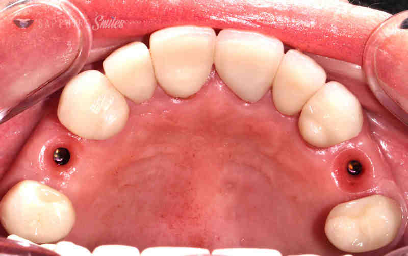 Are black gums permanent?