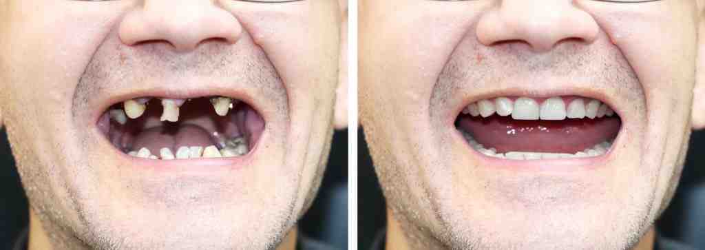Are bridges cheaper than implants?
