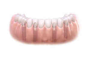 Are dental implants painful?