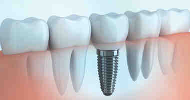 Are dental implants usually successful?