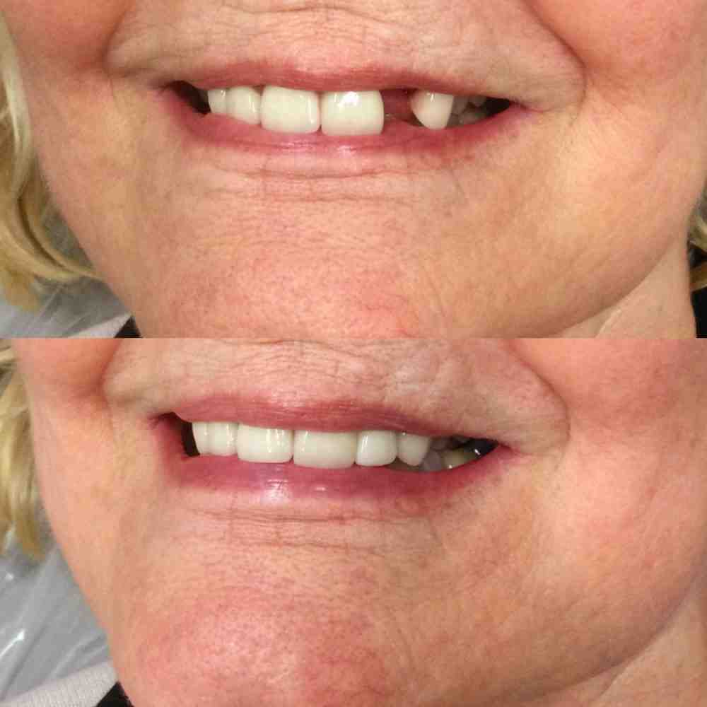 Are dental implants worth it?