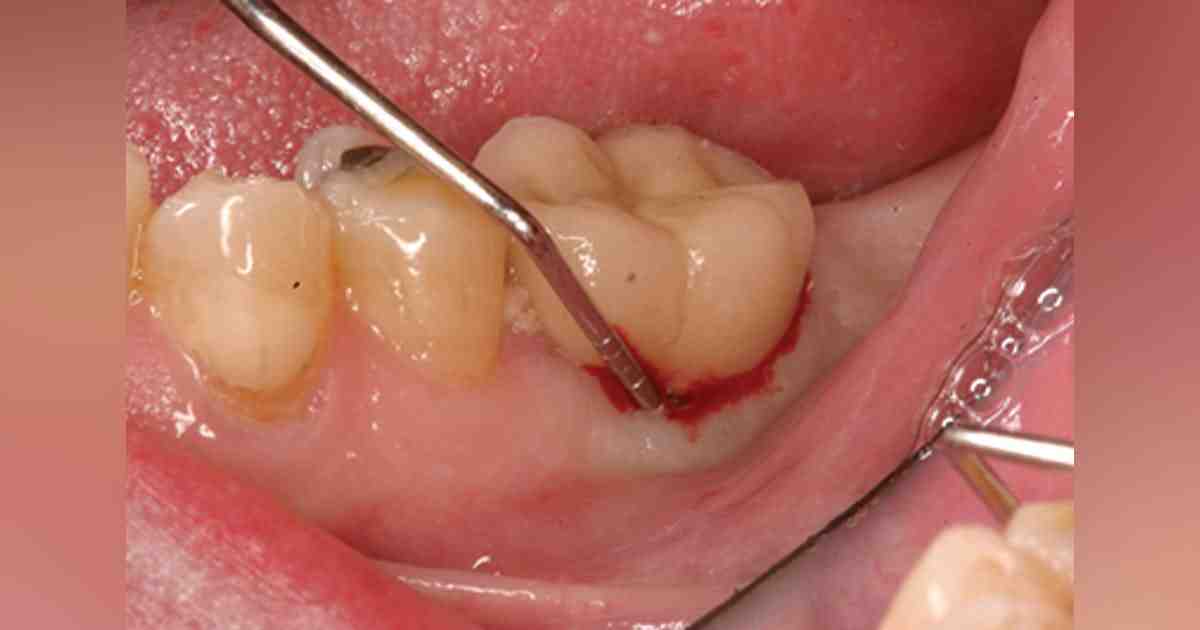 Are dental implants worth the investment?