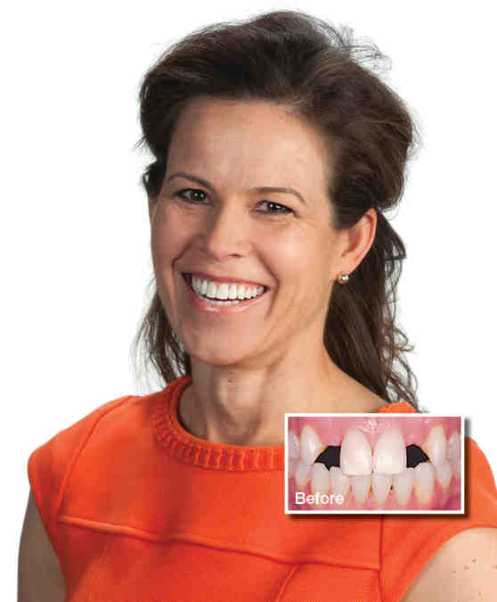 Are dentures or implants better?