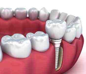 Are snap on dentures worth it?