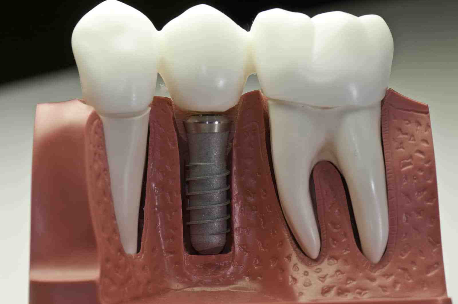 Can I eat pancakes after implant surgery?