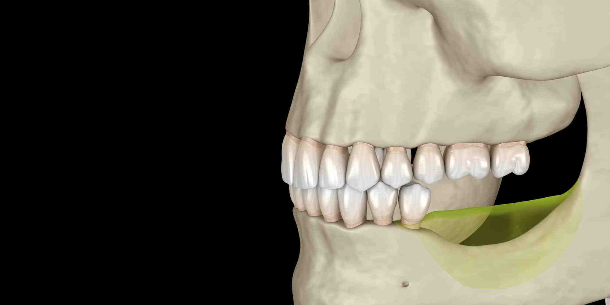 Can I get an implant without a bone graft?