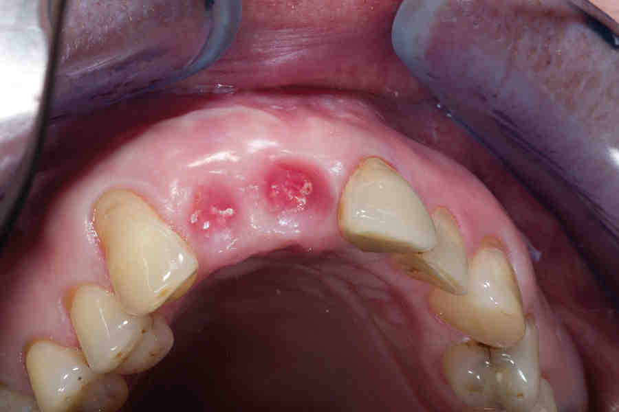 Can I get bone graft and no implant?