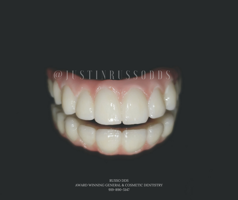 Can I get veneers if my gums are receding?