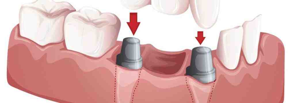 Can I wear my flipper after abutment?