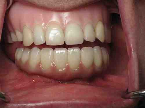 Can Snap In dentures be converted to permanent dentures?