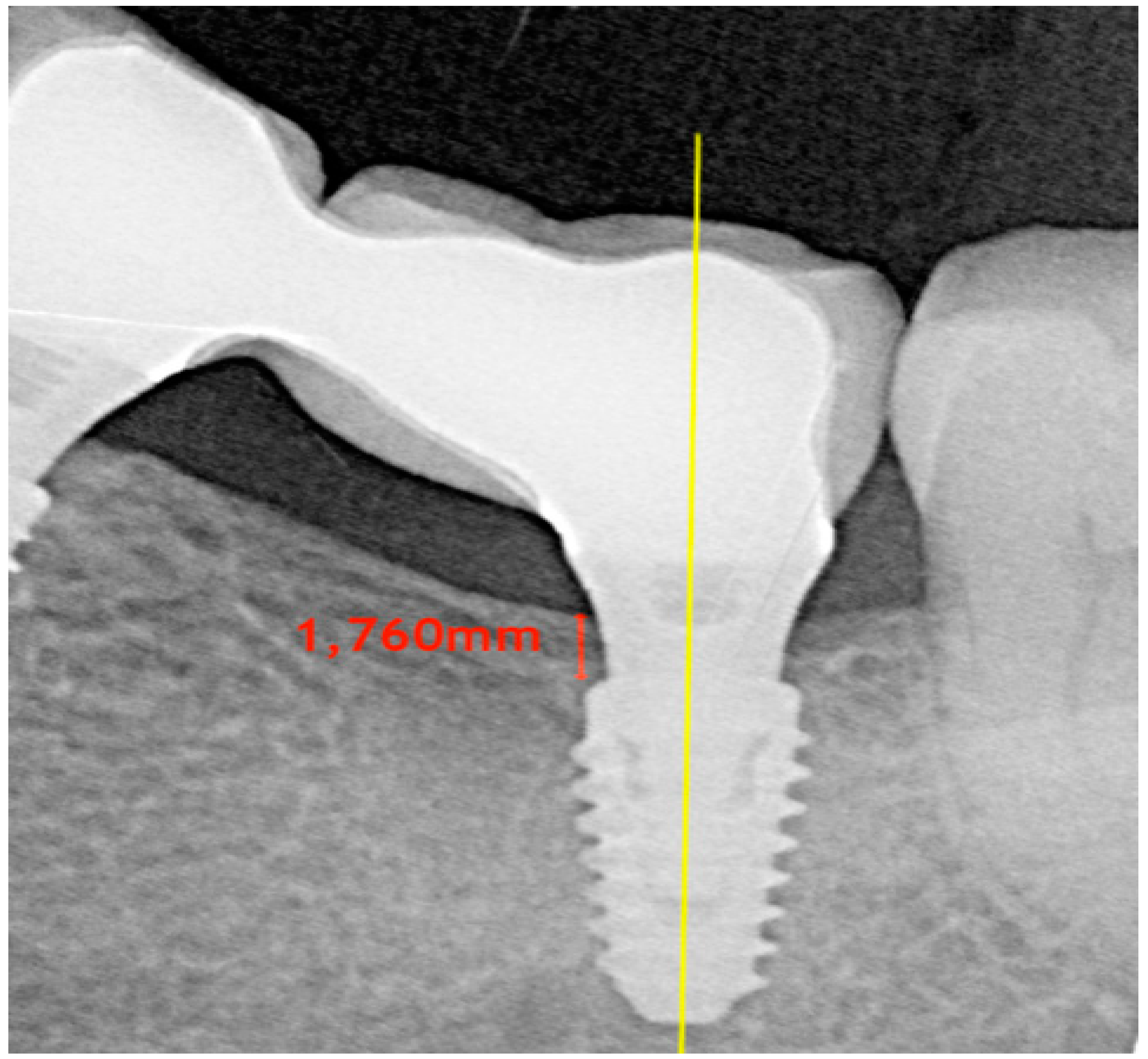 Can Stage 4 periodontal disease be reversed?