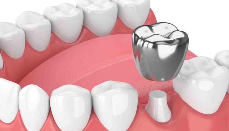 Can a crown be placed over a dental implant