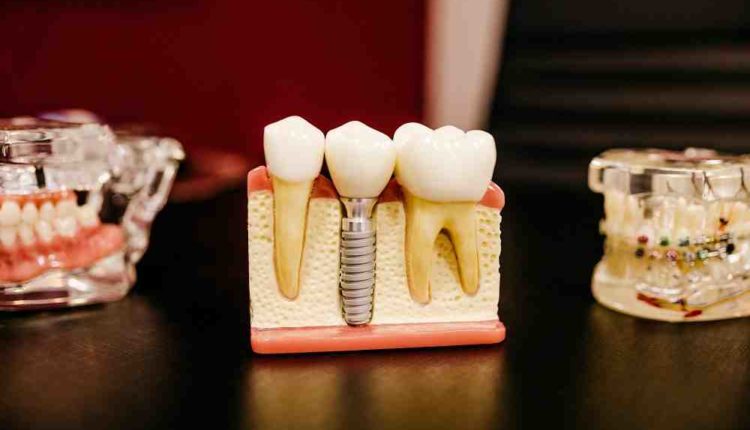 Can a dental implant be put in a gap between teeth