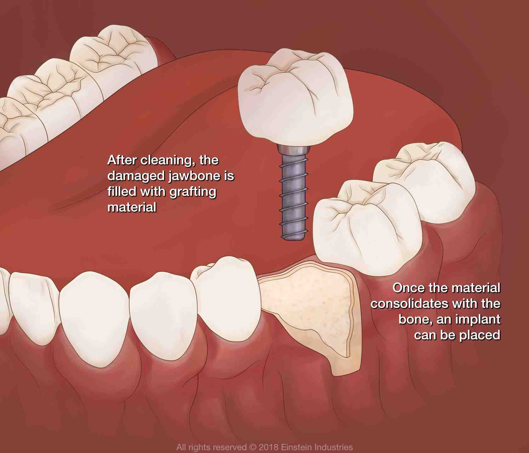 Can a regular dentist do a bone graft?